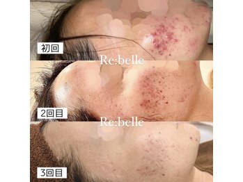 シックスティーエイトフェスター(68FESTAR★)/本気のニキビケア★