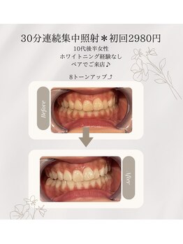 プラスビーセルフ(+b self)/ホワイトニングビフォーアフター