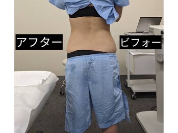 スリーピングビューティー(Sleeping Beauty)/インディバ＋ビタミンC導入