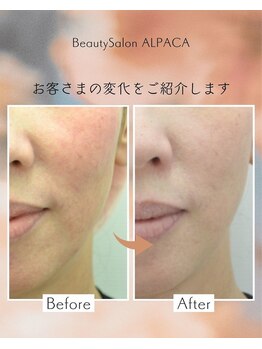 アルパカ(ALPACA)/敏感・リフトアップのお悩み
