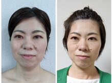 ビュート/一度でフェイスラインスッキリ