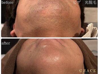グレイス 久留米店(GRACE)/ヒゲ　光脱毛