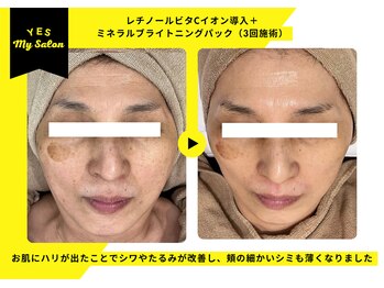 イエス マイサロン(yes My Salon)/ENVIRONトリートメント症例