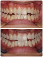 ホノルルホワイトニング 京橋店/6回券 ホワイトニング症例写真