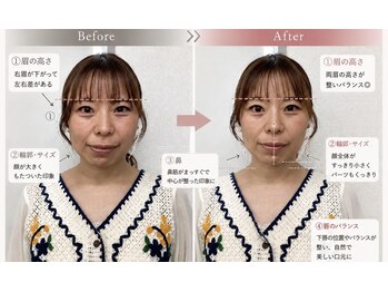 則武の整骨院の写真/【エラ張り・むくみ・左右差に】骨格から整える小顔矯正で理想のフェイスラインへ♪肩こり解消にも◎