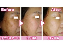 マイン 幸店/しみしわ改善リセラフェイシャル