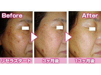 マイン 幸店/しみしわ改善リセラフェイシャル