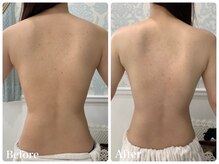 リュミエール デスポワール(Lumiere d'espoir)/背中ハーブピーリング