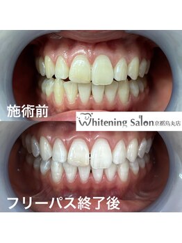 ホワイトニングサロン 京都烏丸店/ホワイトニングサロン施術例