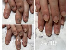 モニカ(Monica)/深爪矯正beforeafter