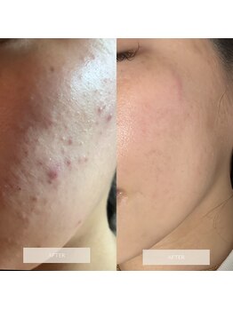 タグ 高知駅前店(Tug)/【ニキビケア】ハーブピーリング