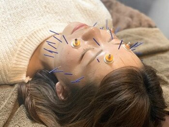アパト鍼灸院(APaT)の写真/≪肌トラブル改善！美容鍼灸[1000本鍼]¥3000≫繰り返すお肌悩みやニキビケアに◎