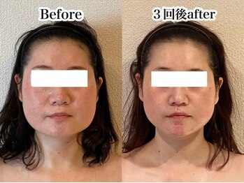 ミベル(MeBell)/【小顔コルギ】エラ張り改善