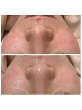 ルコア ドゥ(rucor doux)/あなたお悩み毛穴は何毛穴？