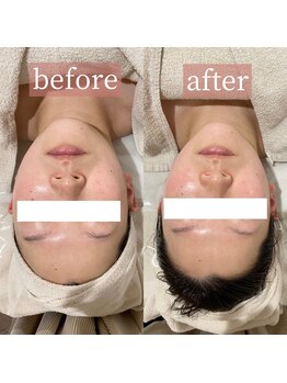 アディクトウラ(Addict'ula)/ウルトラ小顔マッサージ