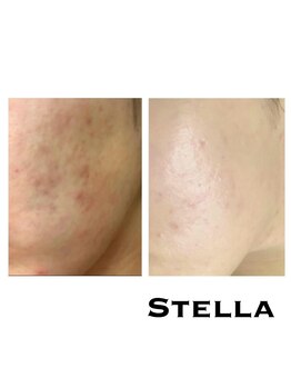 ステラ(Stella)/人気の光フェイシャルエステ♪