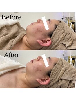 ラ フルール(La Fleur)/エアバリフェイシャル