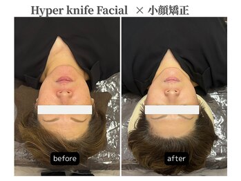 サロン ド グレース(Salon de Grace)/小顔&ハイパーフェイシャル