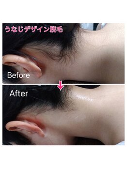 ルアナ(Luana)/うなじデザイン脱毛(^-^)