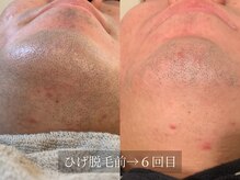 アルム(Arum)/ひげ脱毛