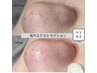【いちご鼻解消】毛穴エクストラクション単体(鼻メイン) 