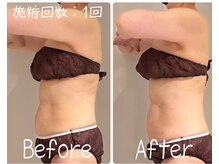 美活ラボ(美活LABO)/初回体験の効果です！