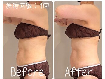 美活ラボ(美活LABO)/初回体験の効果です！