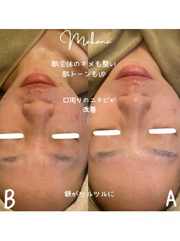 マハナ(mahana)/当店が得意とする肌質改善エステ