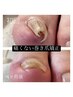 巻き爪矯正！【1本3500円】上からフットネイルも可♪