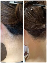 リマ(Lima)/うなじ脱毛