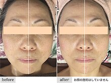 ペルク(perk)/ウルトラ筋膜リリース上半身60分