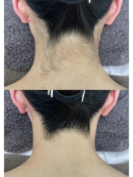 カルディエ(Cardie)/うなじ脱毛　ビフォーアフター