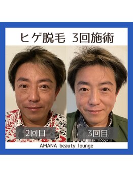 アマナ(AMANA)/3回目でお肌もパッと明るく!