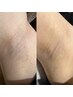 【学割U24】ワキ脱毛　初回3,300円⇒1,100円