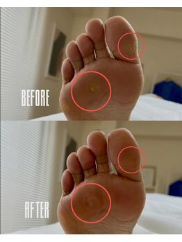 おん/前足部のタコ