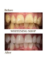 ホワイトニングショップ 元町 中華街店/美白ホワイトニングBefore&After