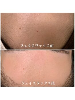 ミーサ(Mysarest)/おでこのムダ毛で女性力アップ☆