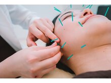 メタ鍼灸院/小顔美容鍼