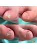 【副爪１箇所（小指の爪横にあるモノ）】+【足の爪切りセット】