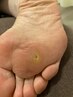 【魚の目を芯から取りたい】専用の機器で取ります♪ 30分¥7,980→¥5,500