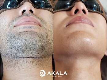 メンズ脱毛サロン アカラ(AKALA)/ヒゲのビフォーアフター
