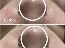 アンリミット 鹿児島天文館店(Une limit)/毛穴撲滅