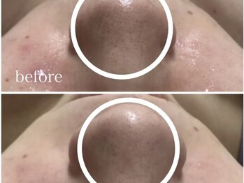 アンリミット 鹿児島天文館店(Une limit)/毛穴撲滅