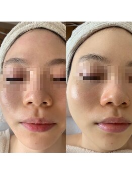 ナヴィータ アオバダイ(Navita AOBADAI)/エンビロン/2ヶ月集中コース