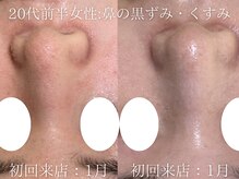 ブリエ(Briller)/毛穴洗浄＋幹細胞トリートメント