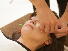 セントラルたなか鍼灸院 上社院/・美顔鍼の施術