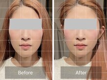 菫鍼灸院の雰囲気（電気を流す頭皮鍼付き全顔美容鍼で、左右差やたるみを改善します）