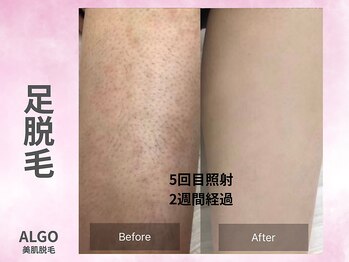 アルゴ 山口宇部店(ALGO)/脱毛初めて5回でこの仕上がり!