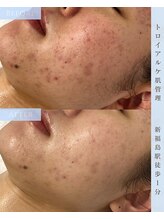 ヴィノ フクシマ(VINO FUKUSHIMA)/ニキビ、赤み、毛穴開き