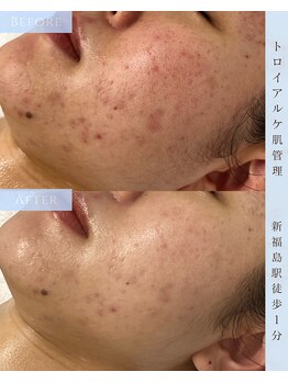 ヴィノ フクシマ(VINO FUKUSHIMA)/ニキビ、赤み、毛穴開き